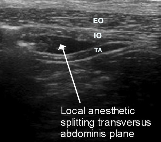 Splitting of the transversus abdominis plane