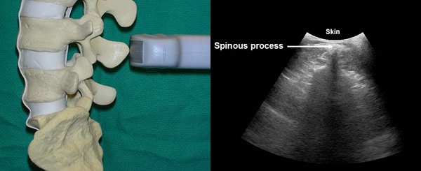 spinous process in transverse plane