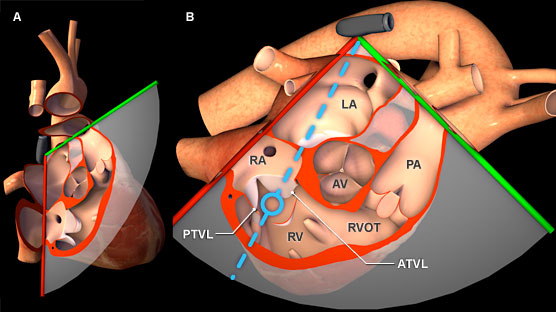 TEE plane position for spectral Doppler of tricuspid valve