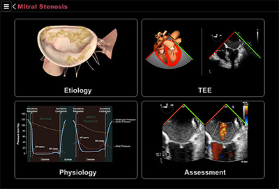 Mitral Stenosis menu